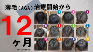 【効果なし？】AGA治療12ヶ月の効果を公開！フィナステリド・ミノキシジルの効果を画像メインで解説！ 